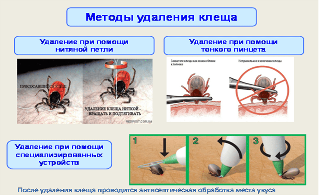 Как удалить клеща у человека самостоятельно. Методика удаления клеща алгоритм. Алгоритм удаления присосавшегося клеща.